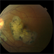Macular Serpiginous Choroidopathy Macular Serpiginous Choroidopathy